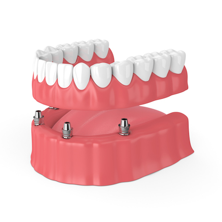 photo of an implant supported denture
